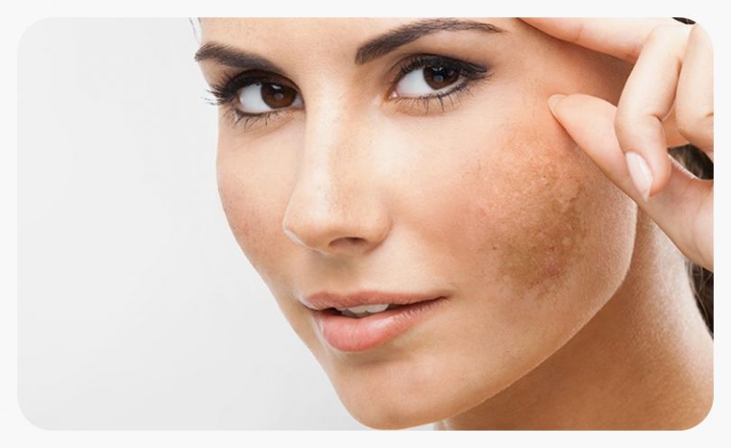 Melasma pigmentation treatment